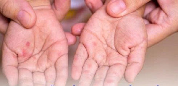 05 01 2026 Tuyên truyền phòng chống dịch bệnh tay chân miệng